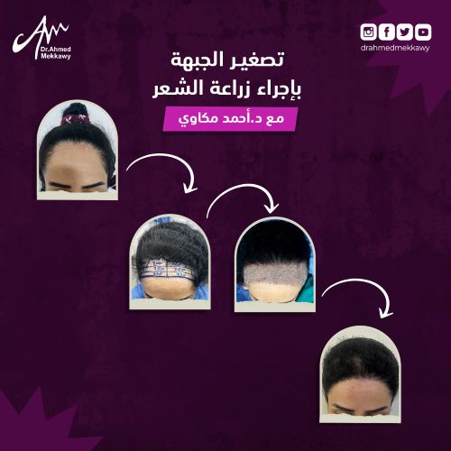 زراعة الشعر قبل وبعد للنساء